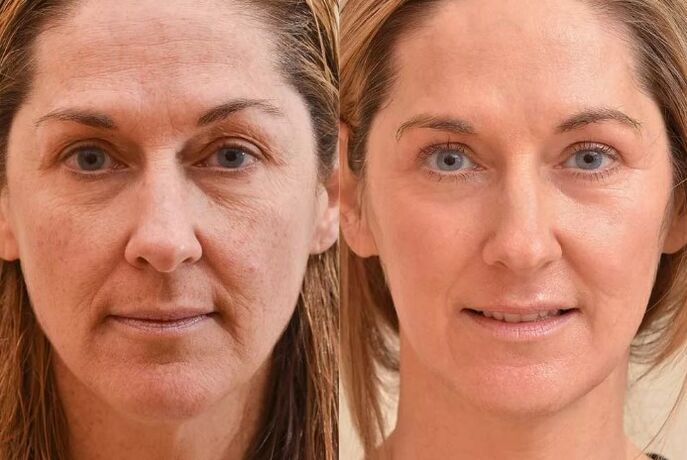 Verjüngung des Gesichts vor und nach