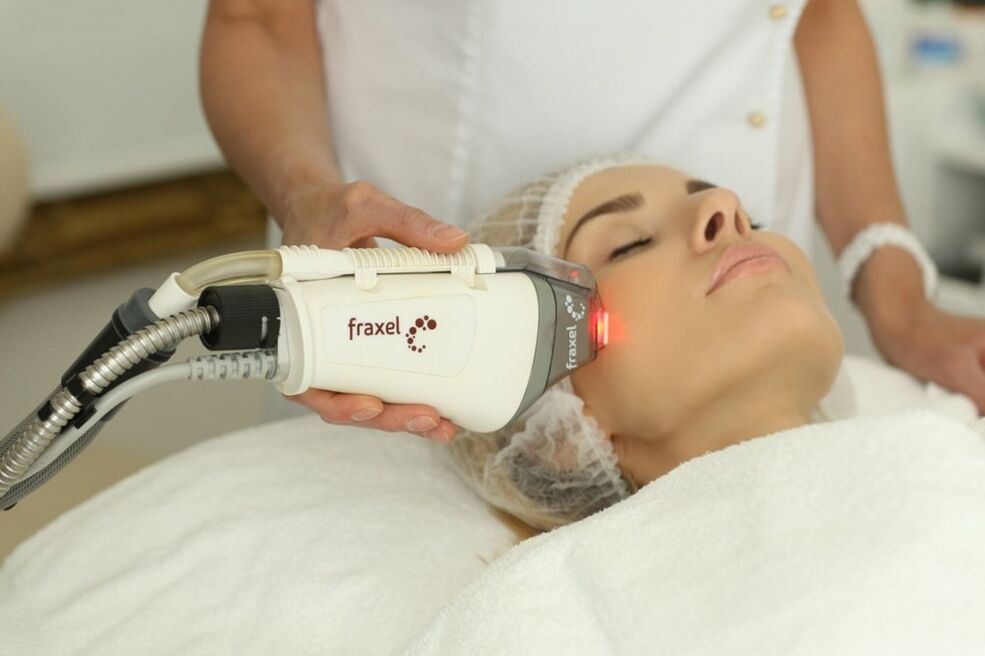 Laserverjüngung