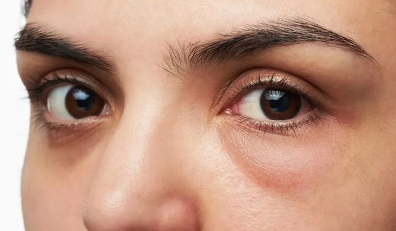 Taschen unter den Augen, Schwellung