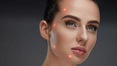 Was ist eine fraktionierte Hautverjüngung