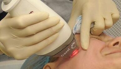 Wie wird eine fraktionierte Hauterneuerung durchgeführt