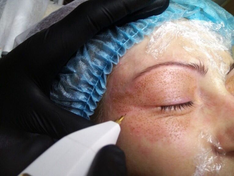 Plasma-Lifting-Verfahren.