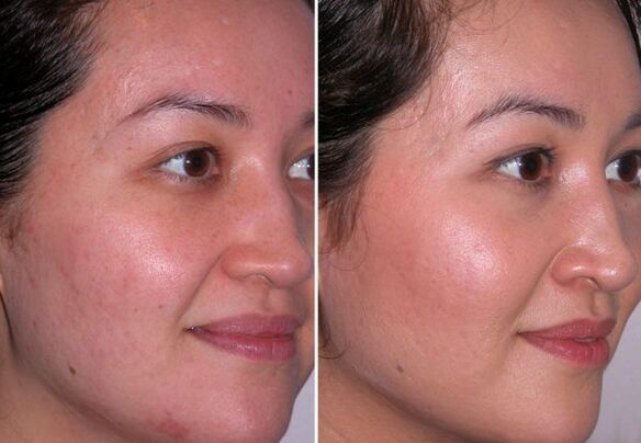 Mikrodermabrasion-Kurs