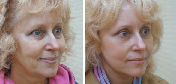 Frau vor und nach der Gesichtshautverjüngung mit Plasma. 