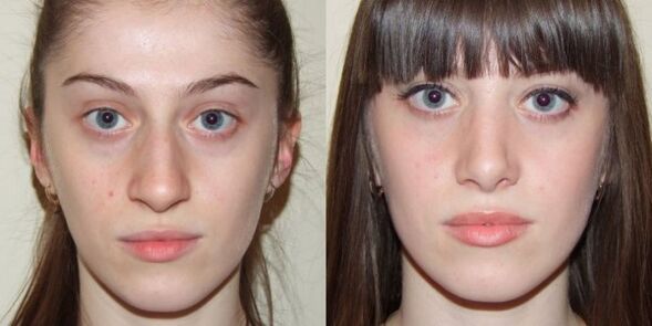 Mädchen vor und nach der Gesichtshautverjüngung mit Plasma. 